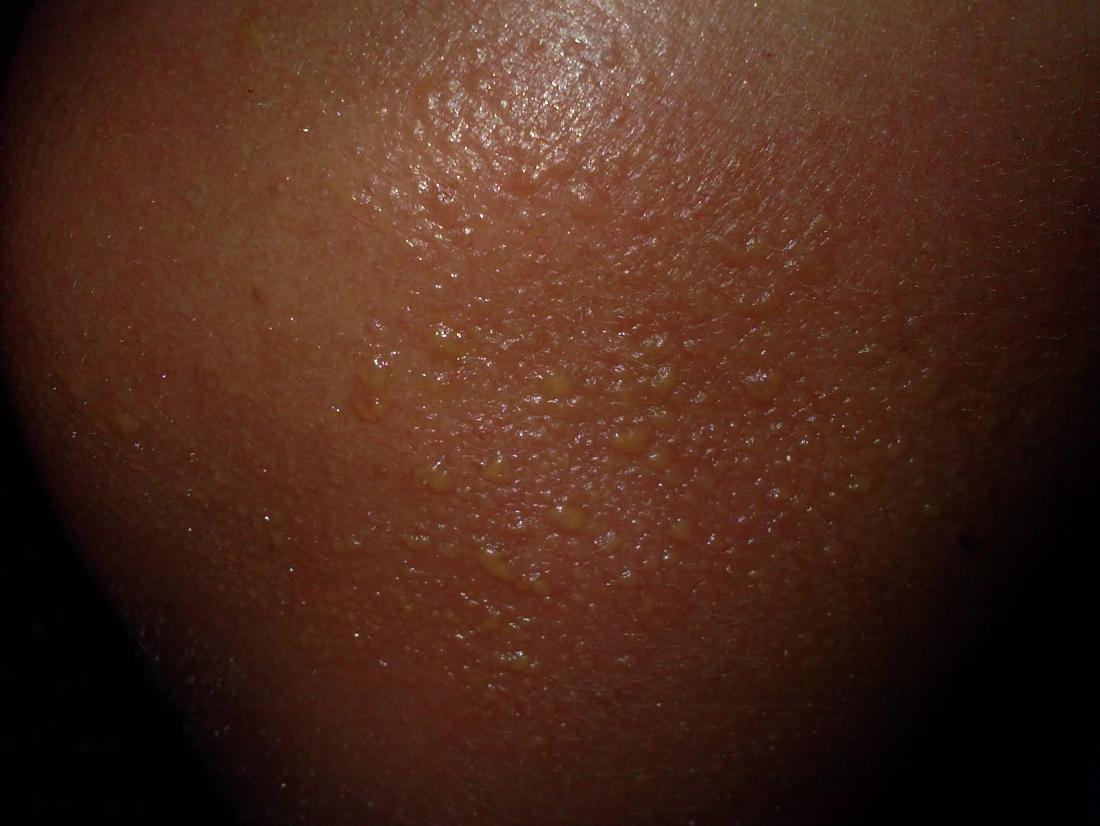 Sensitive Skin