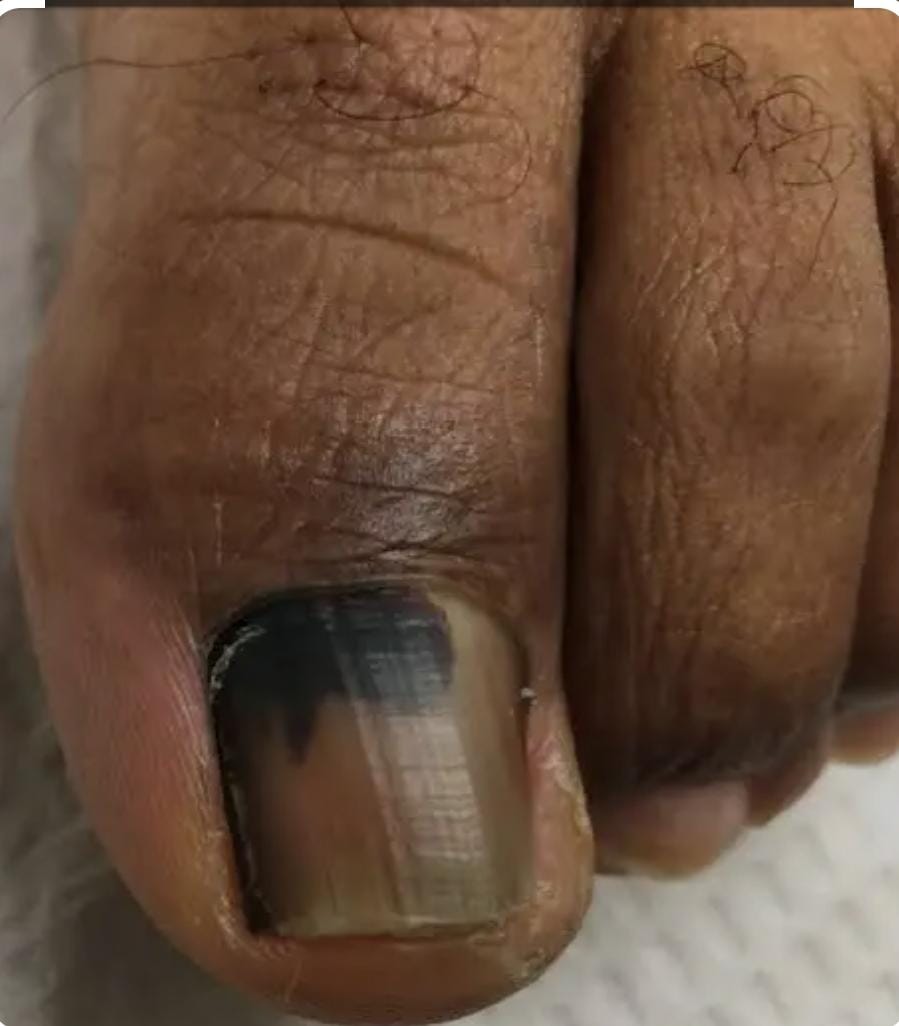 Nail Disease